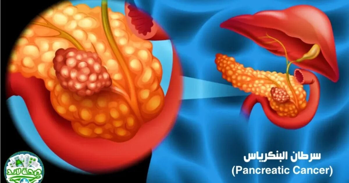 Revolution Medicines تحصل على موافقة أميركية لعلاج سرطان البنكرياس